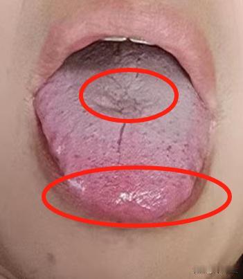 舌头厚腻黄可不是小问题，有这样症状可要当心了，多是身体里的湿邪搞的鬼

主诉：口