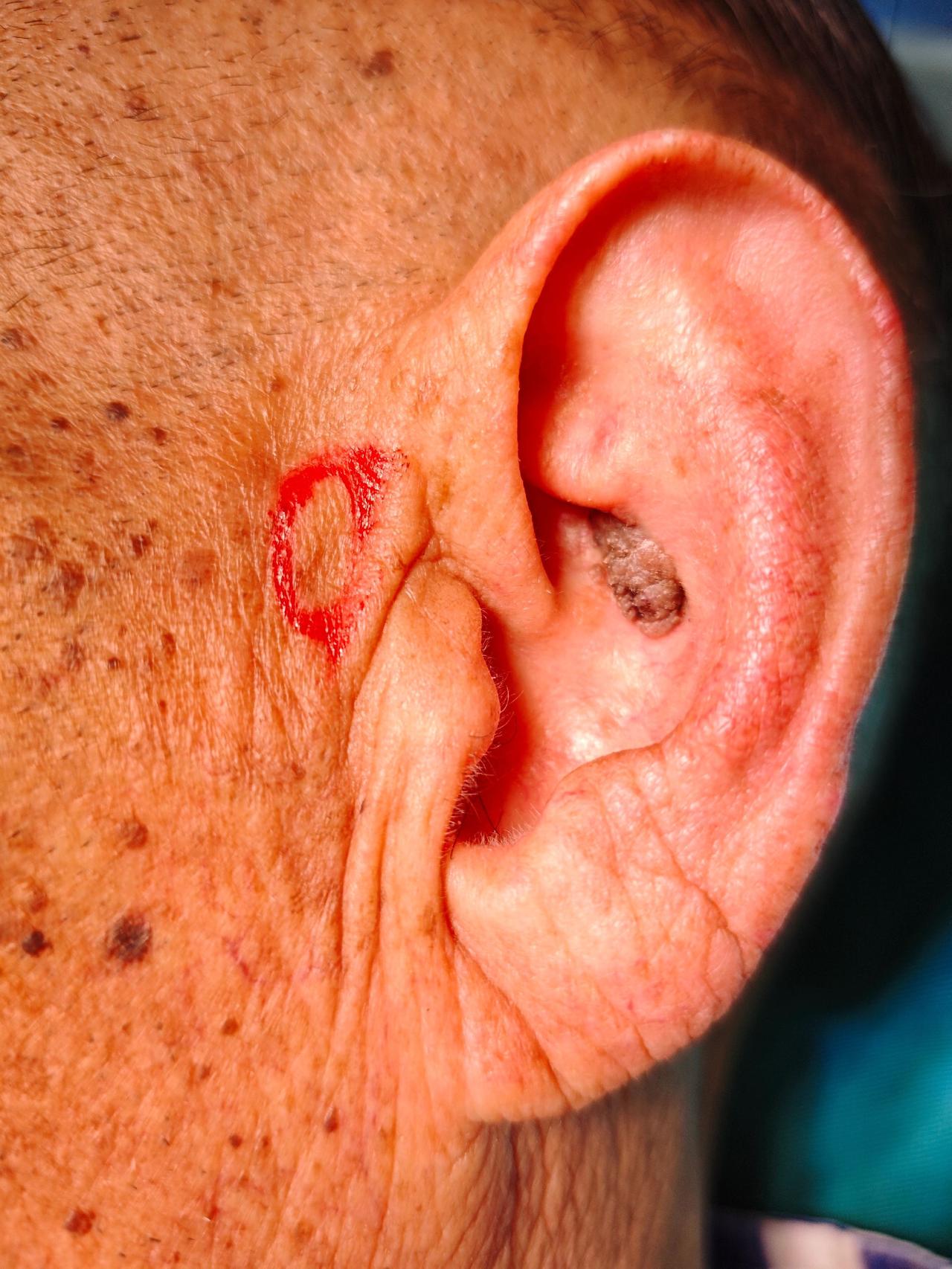 耳后沟皮瓣修复术后16天情况。之前做的耳后沟皮瓣修复患者，老人家今天发来照片，皮