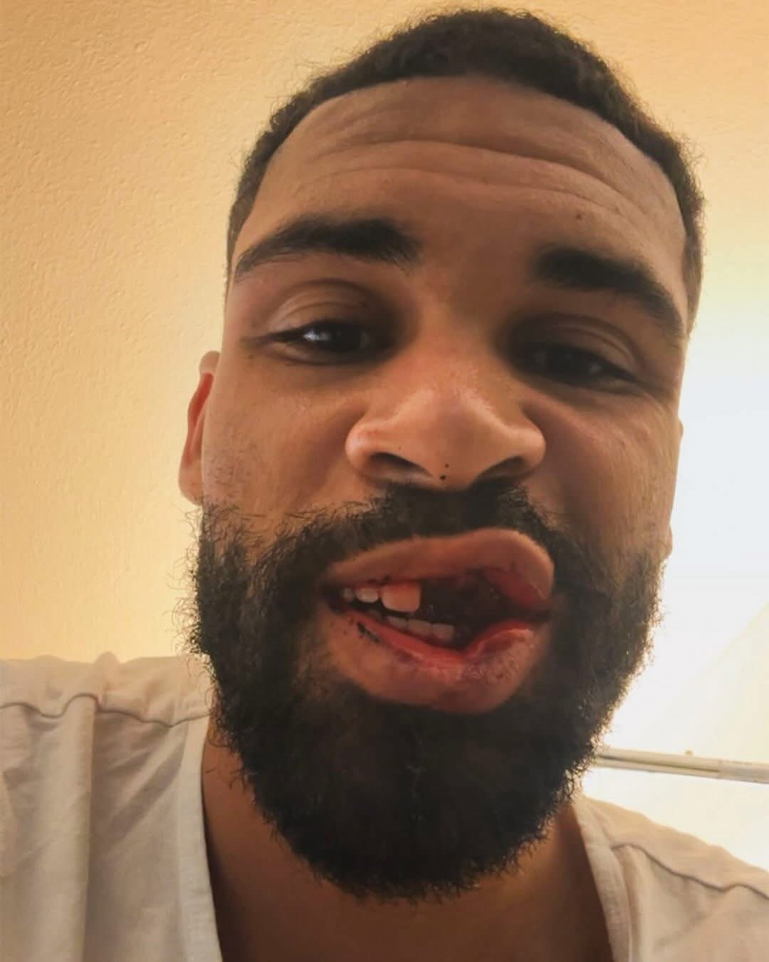 盧夫杜斯卓克：影像令人震驚，但牙科手術已順利完成，預計兩個月後重返球場。💪🏾