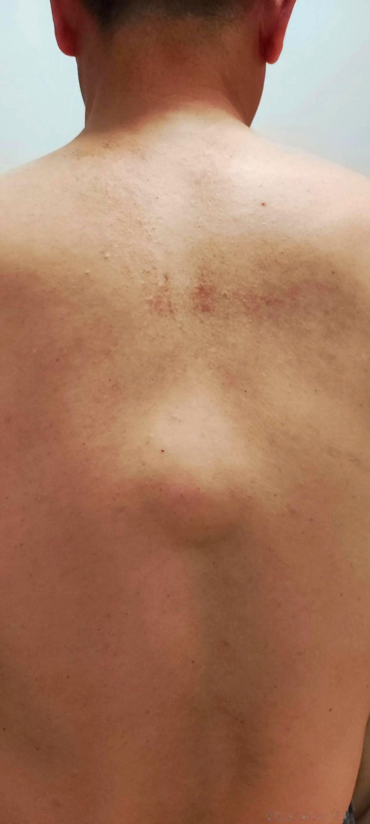 后背悄咪咪长了颗“鸡蛋”，老婆急得跳脚我却说放着呗？
那天热得跟蒸笼似的，我穿着