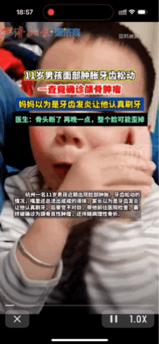 危险还是发生了！杭州一名11岁男孩子右侧脸肿、牙齿松动，家长误以为是普通牙龈发炎