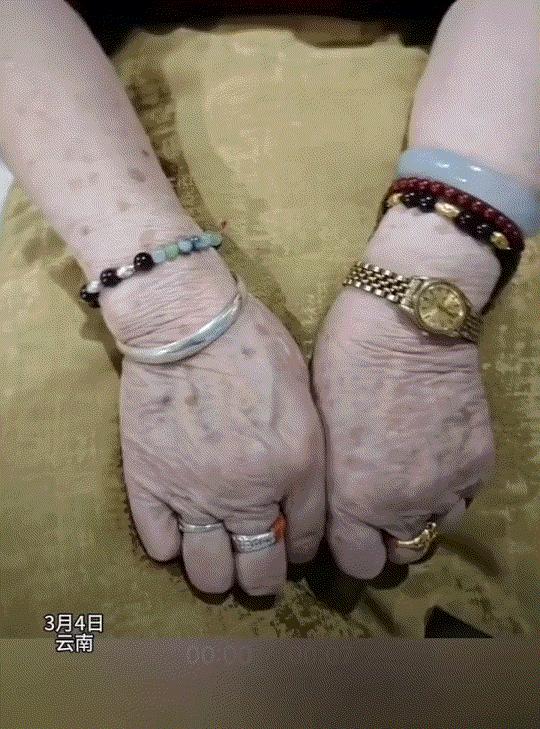 云南，一女子发视频分享，她这天和奶奶聊天时无意间发现，奶奶戴了三十年玉镯的手，和