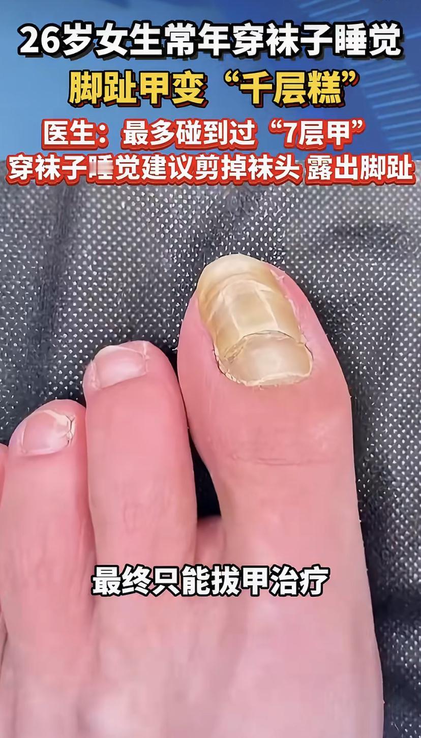 杭州一个26岁姑娘，冬天脚冷爱穿袜子睡觉，结果脚趾甲被闷成了"千层糕"，一层层裂