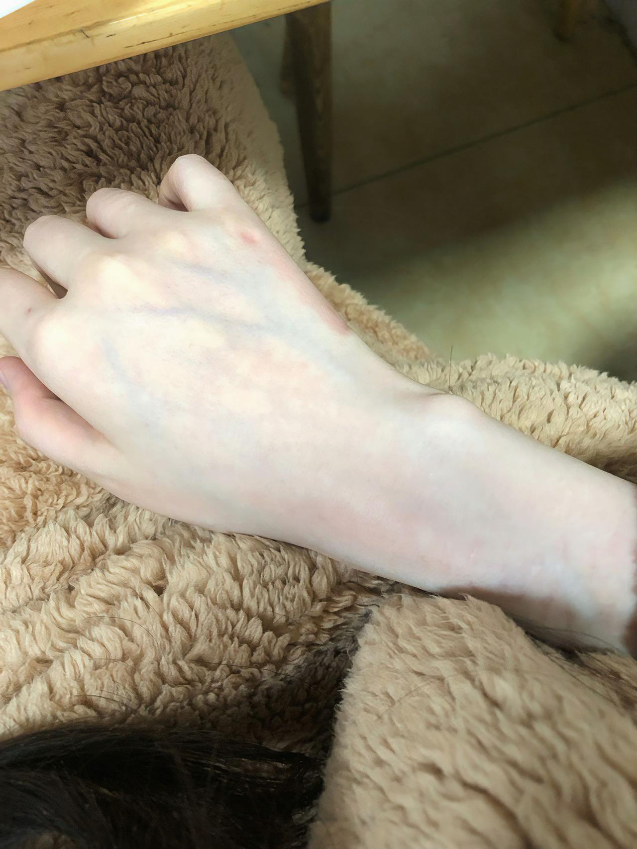 我的手正常吗？是皮太薄了吗？