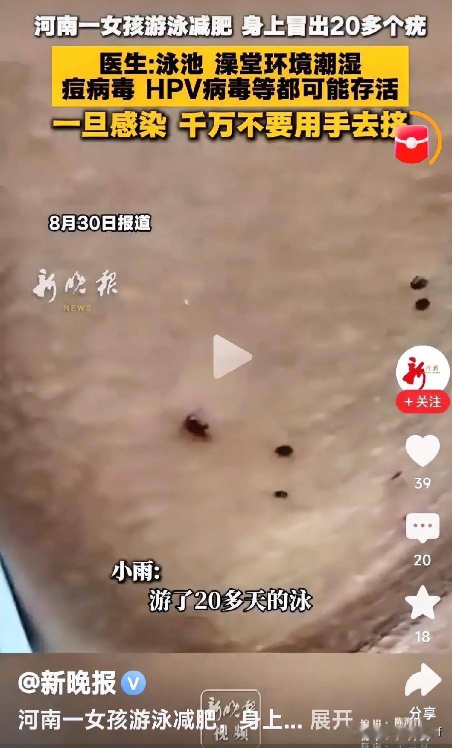 22岁的晓雯想靠游泳减肥，办了健身房年卡，每天游一小时。可两周后手臂冒小疙瘩，她