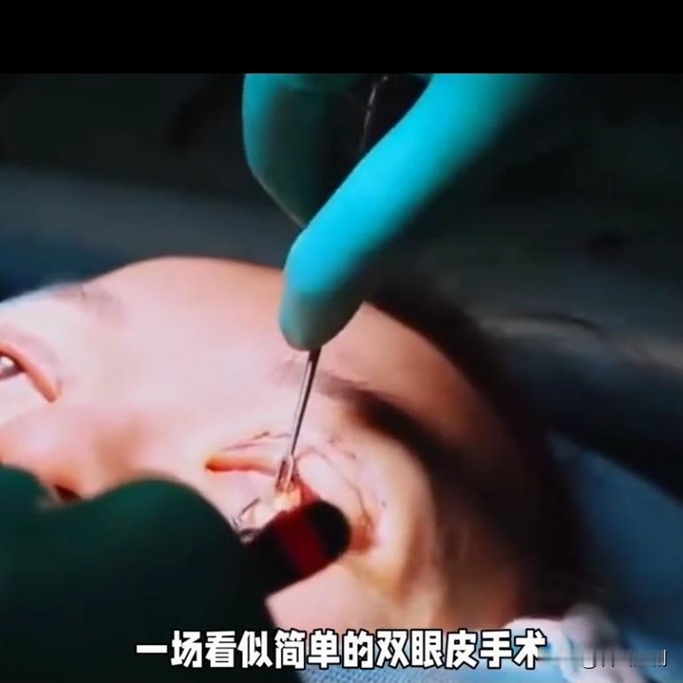 女子割双眼皮致残，签谅解书反赔20万

谁能想到，花1.2万割双眼皮，这辈子眼睛