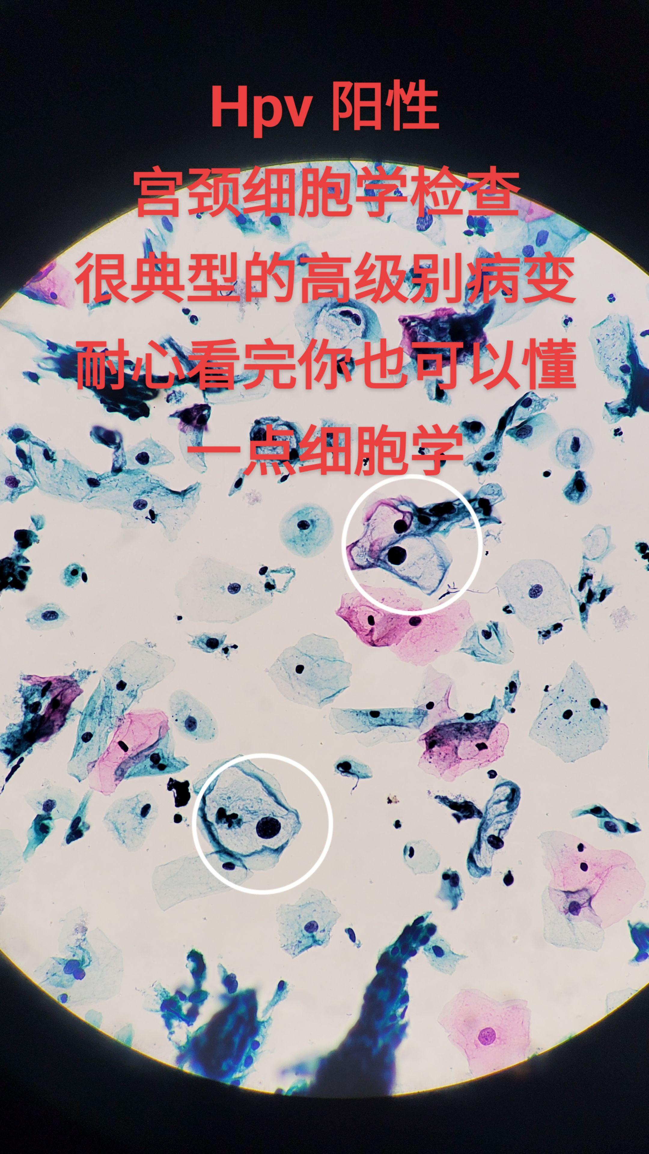 宫颈细胞学 hpv 挖空细胞