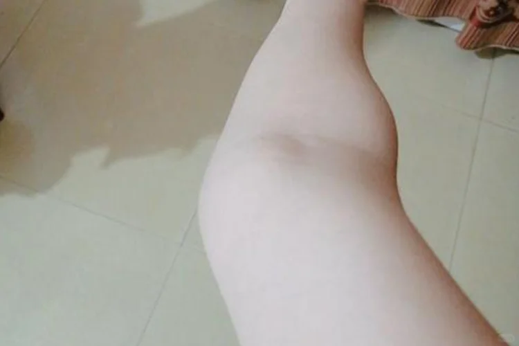 手肘外翻图片