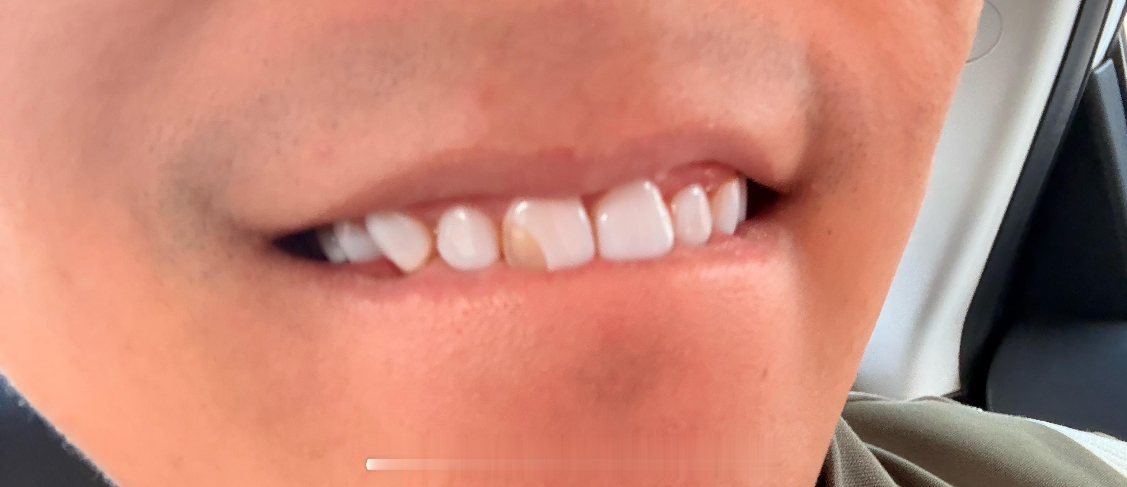 牙贴片崩了，笑死。 