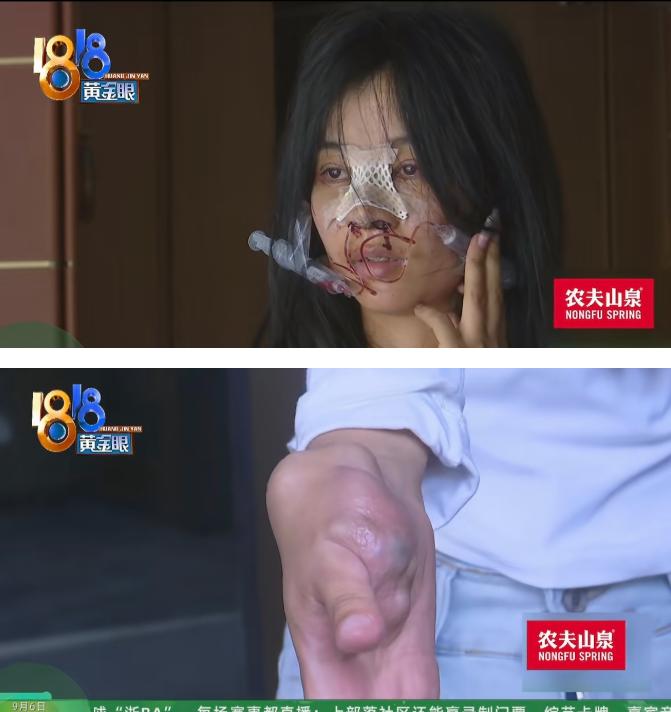 浙江杭州，一女子右手患血管瘤，治疗需要20多万，她为了挣钱治病，去一家KTV面试