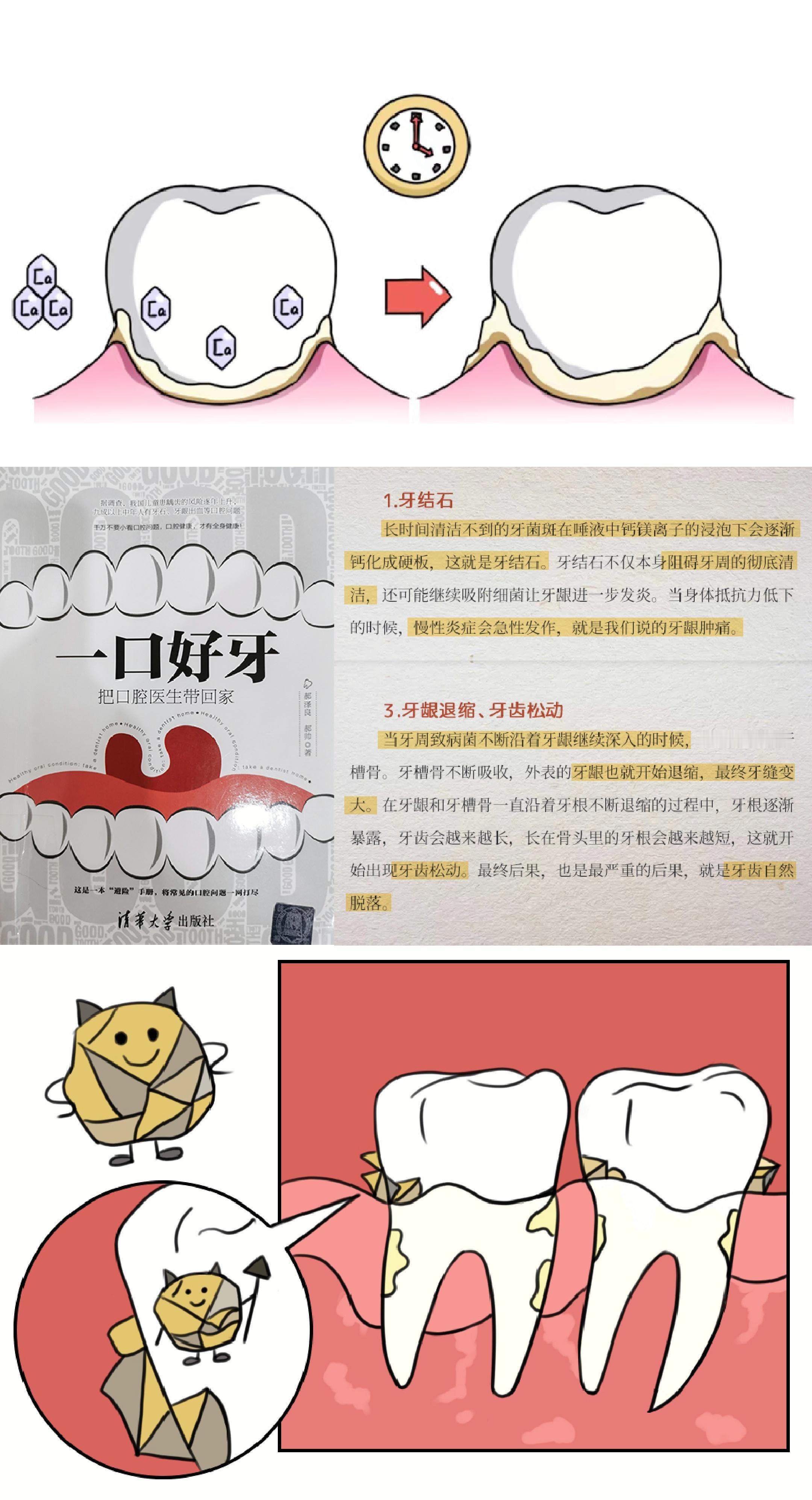 今天来聊聊口腔中烦人的家伙——牙结石！牙结石是什么？怎么来的？牙结石就是牙菌斑放