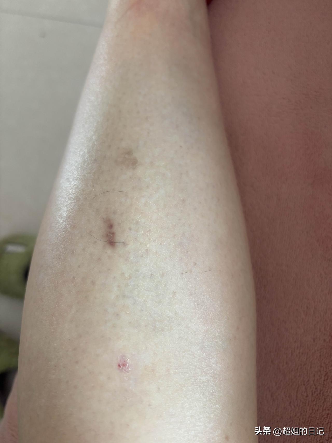 这是我受伤的腿，老杨让我去拍个片子，我感觉没必要。

昨天去办事，拐弯东西掉了，