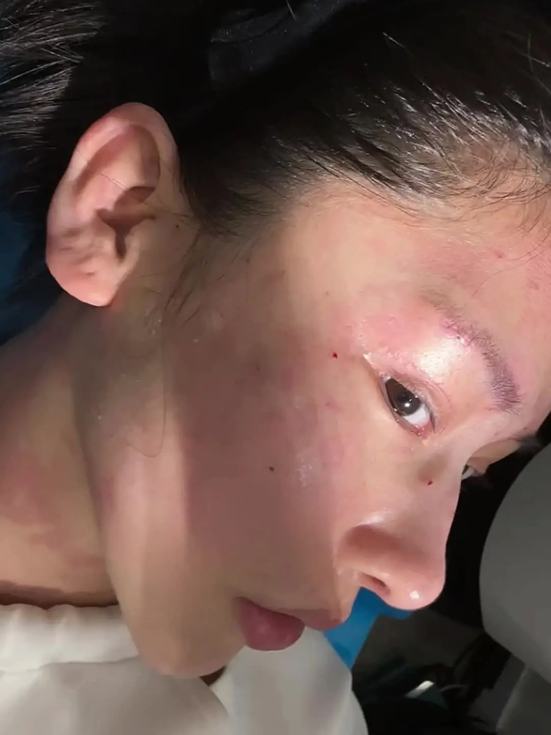 50w 3次全麻 2次局部麻醉 无数针剂 每次痛得不行的时候都发誓再也...