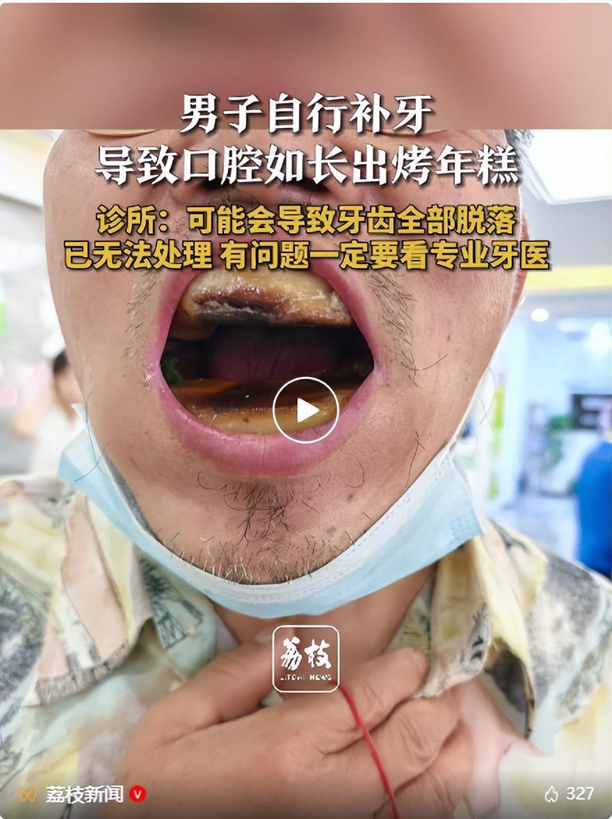 “胆子太大了！”天津，一男子由于不舍得花钱镶牙，自行网购5元补牙材料，结果满嘴的