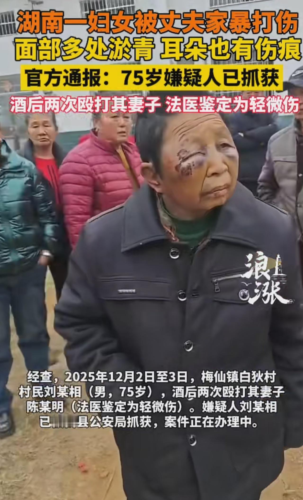 这老头75年真的是白活了，还家暴？
湖南一妇女被丈夫家暴打伤
面部多处淤青 耳朵