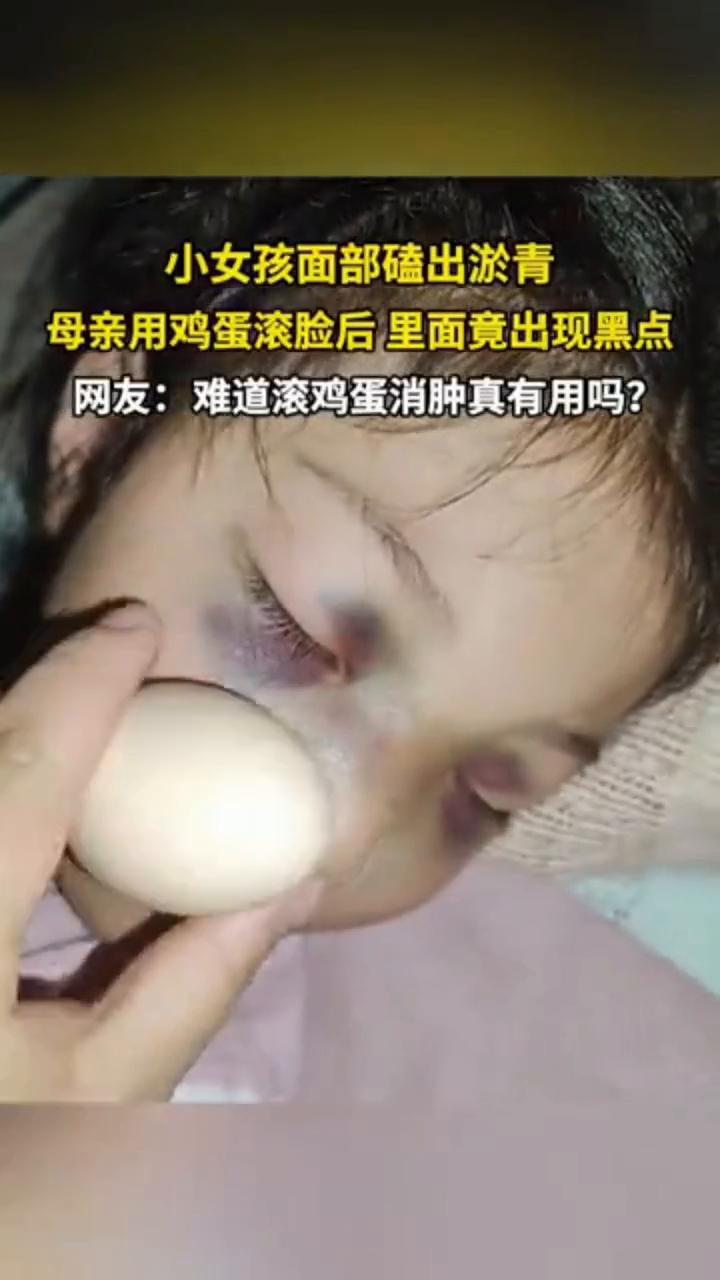 小女孩面部磕出淤青，母亲用鸡蛋滚脸后里面竟出现黑点。
网友：难道滚鸡蛋消肿真有用