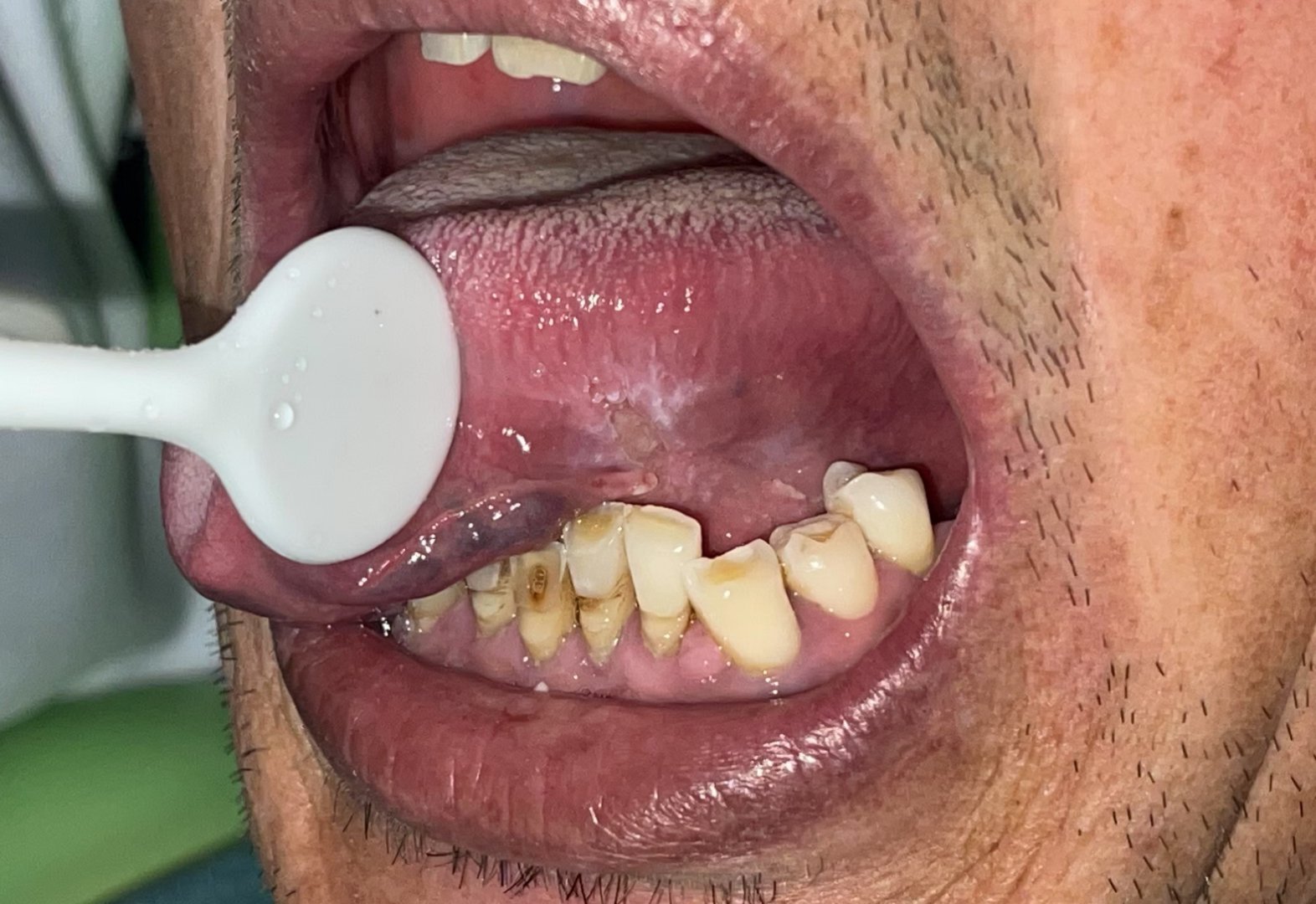 又一例舌创伤性溃疡三周不愈者，调磨残根锐尖后即痊愈了。类似于这种情况而拖延两三个