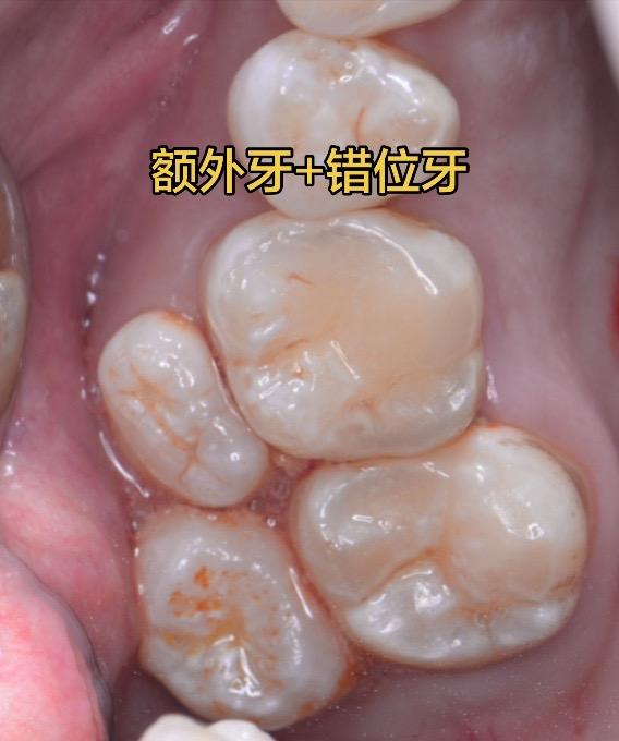 额外牙+错位牙。