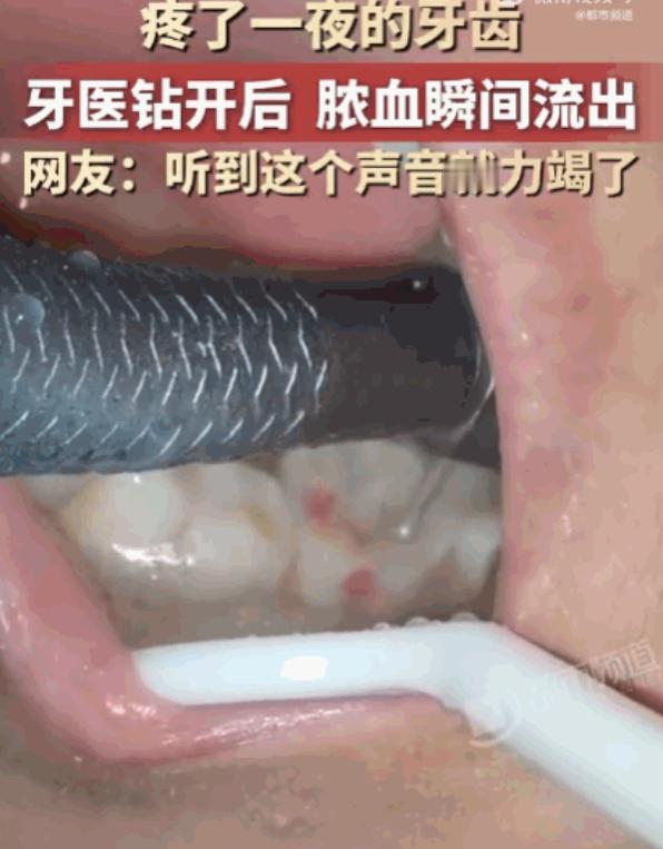 看着都疼！河南，一男子深夜突发剧烈牙痛，整整一夜被折磨得死去活来，崩溃至极。次日