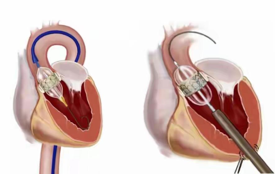 28万“天价”瓣膜引发全网热议，网友纷纷质疑是否存在宰客行为。涉事医院回应称，该