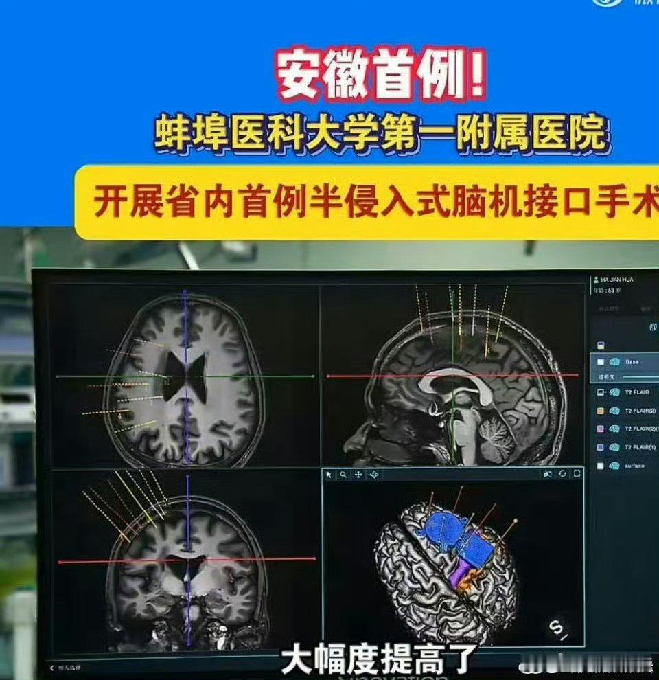 安徽首例半侵入式脑机接口手术成功从实验室到临床，安徽迈出关键一步！4月9日，半侵