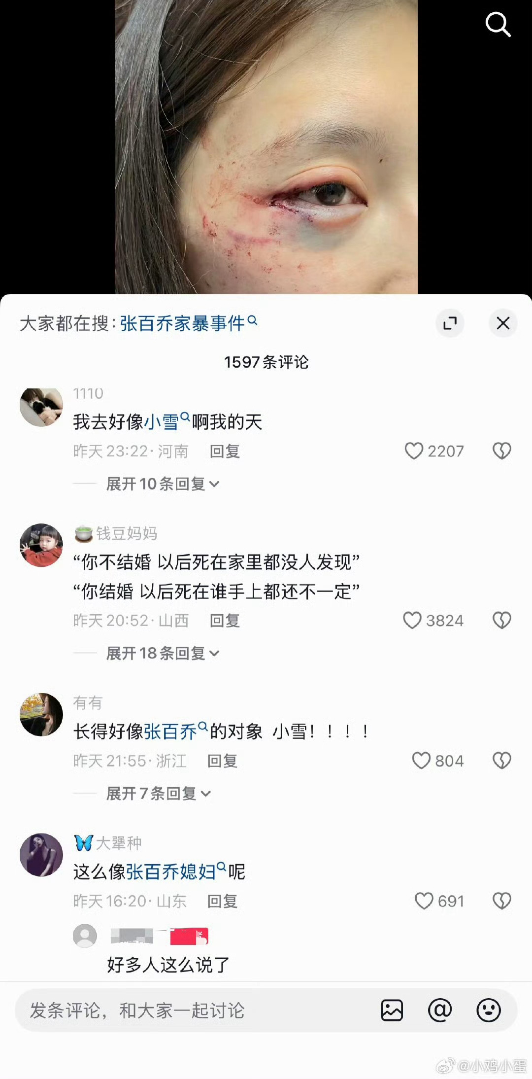 张百乔老婆回应被家暴不是她 小雪眼周有很明显的突起 类似扁平疣一样的 这个人脸上