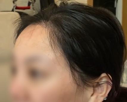 韩国现在主流的发际线审美，更强调保留真实毛流感的同时，让五官视觉重心更加集中。对