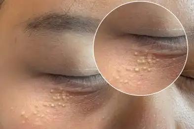人有没有糖尿病，看脸就知道？提醒：血糖超标者脸部常有4种变化——你的脸，可能正在