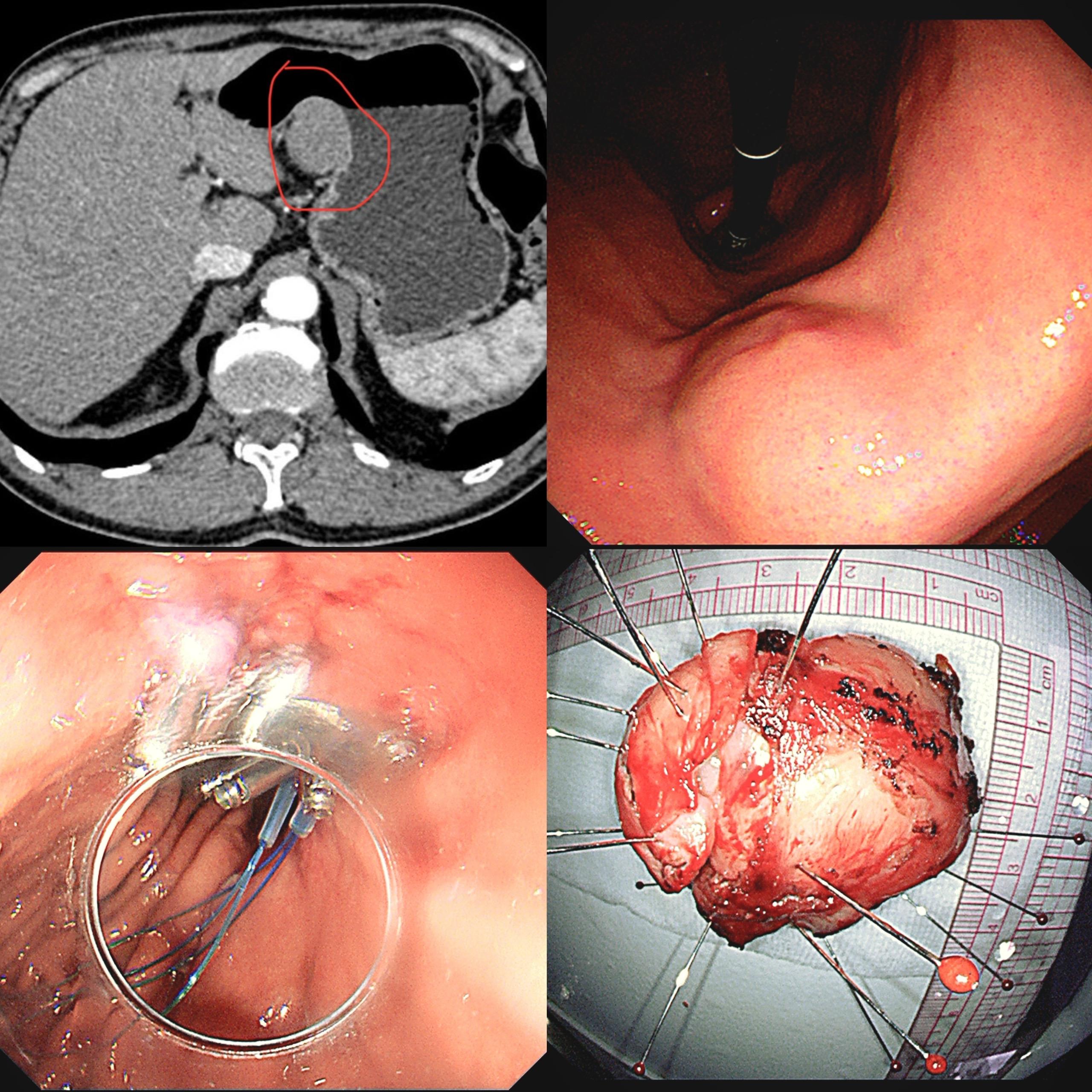 地狱级间质瘤切除！胃角大部分胃壁外生长 近4CM的间质瘤，难切也难缝...