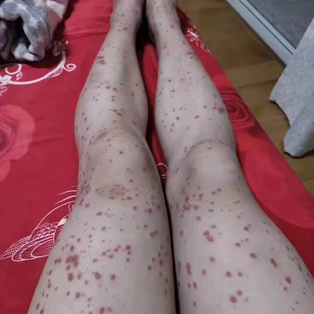 好吓人！
这是得了什么怪病吗？
有知道的吗？会不会
传染呀！？