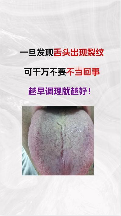 舌面一旦出现裂纹，千万不要不当回事，越早调理越好！


#养生##中医#