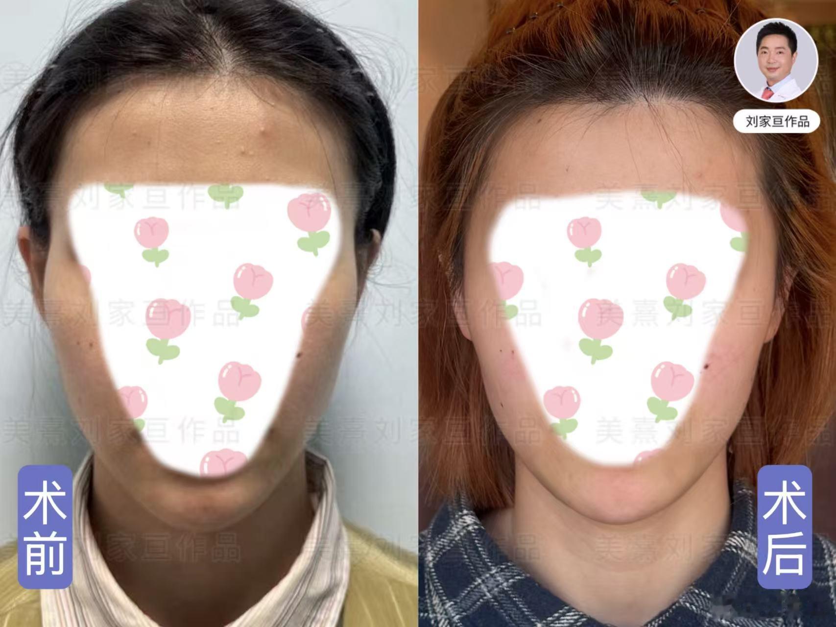 假体丰太阳穴，做完后脸形是不是好看很多，轮廓也流畅了