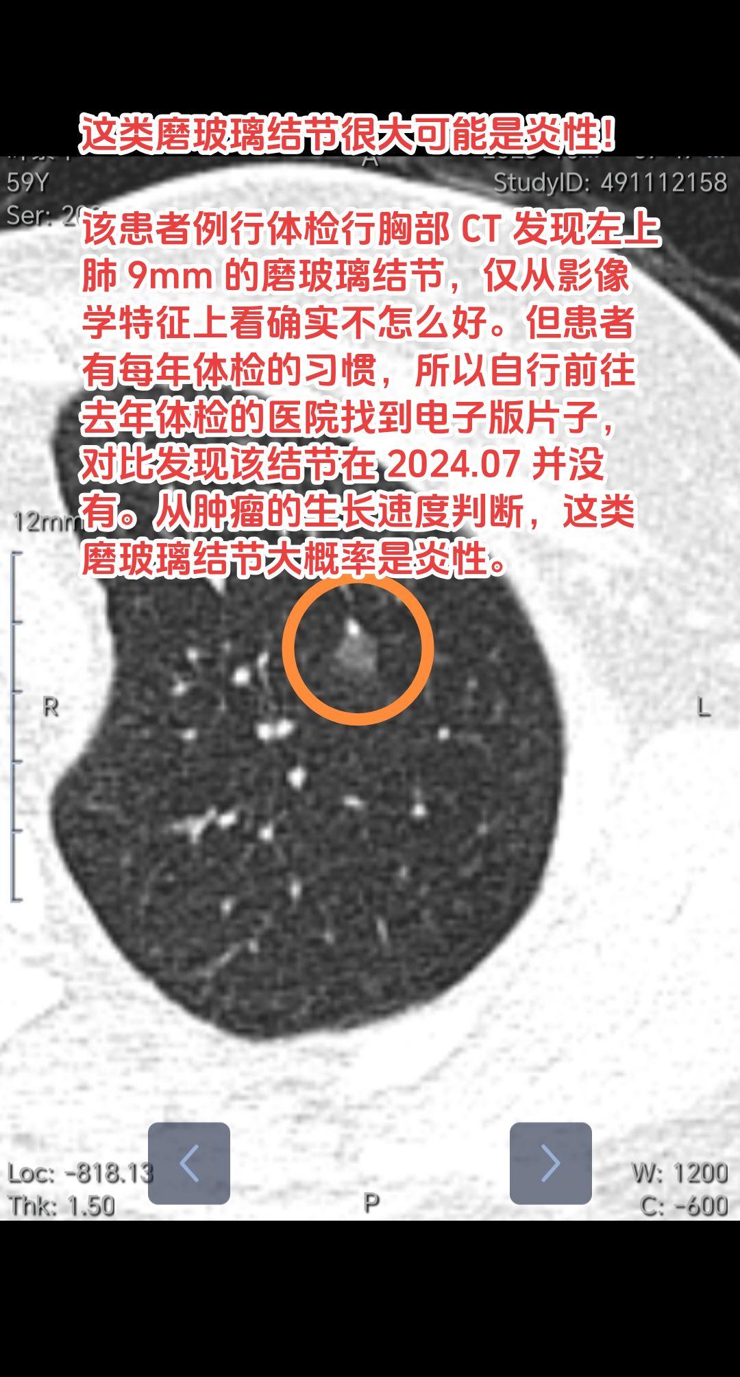 这类磨玻璃结节很大可能是炎性！该患者例行体检行胸部 CT 发现左上肺 ...