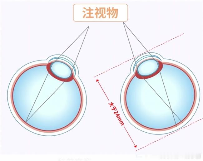 爱尔眼科:长期侧躺玩手机会导致屈光参差?侧躺着看手机时,双眼视物距离不等,动用的