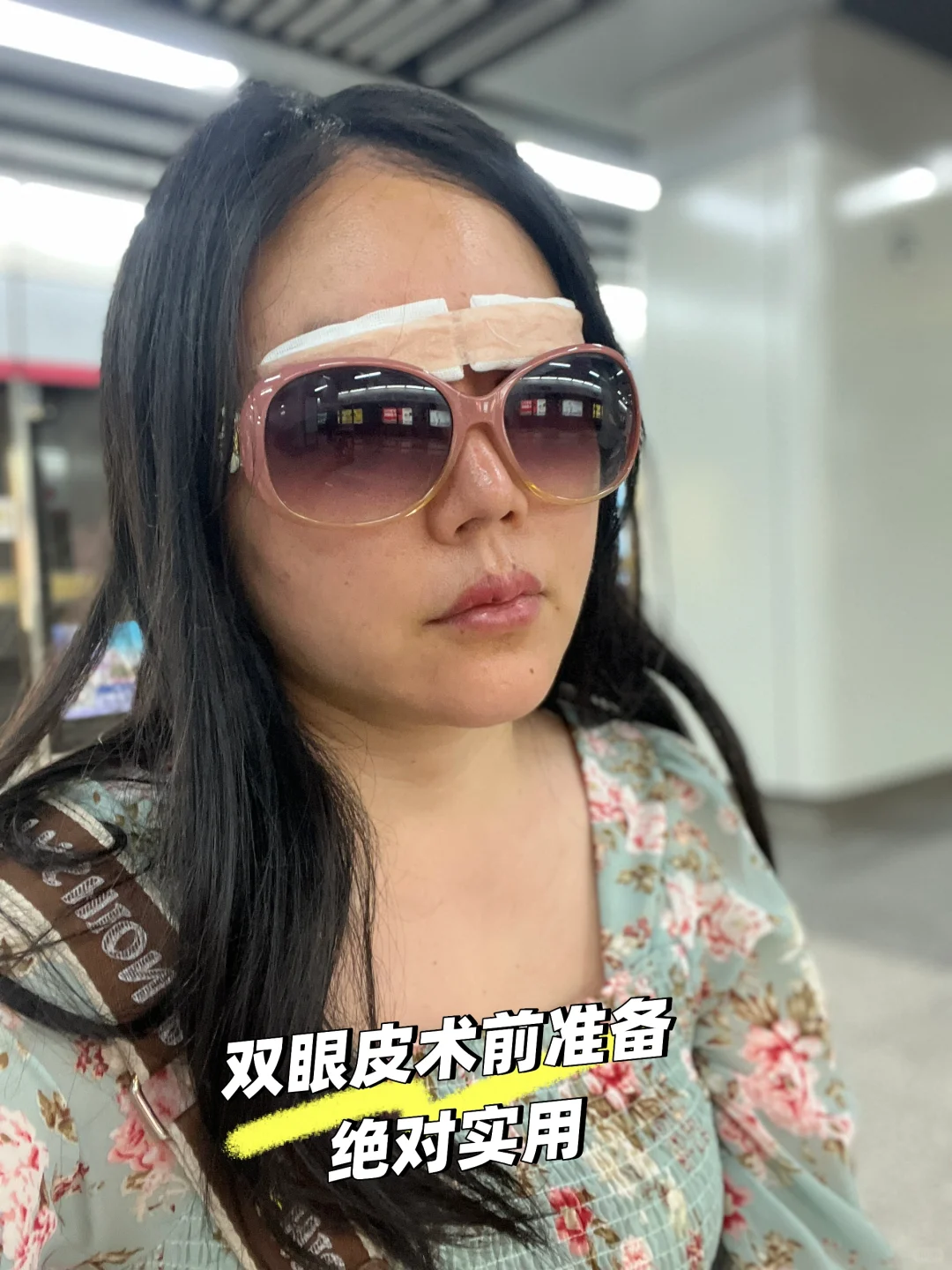双眼皮术前准备清单超实用