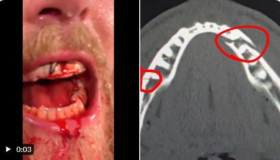 【黄金时代】杰克·保罗证实安东尼·约书亚打断了他的下巴。美国和欧洲当代史川普主义