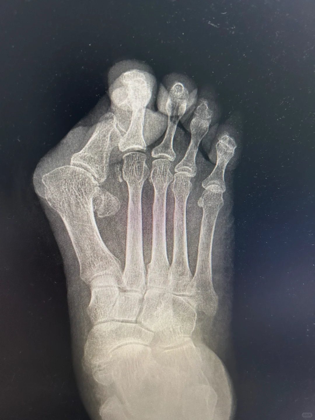 为什么有的老人拇外翻非常严重？