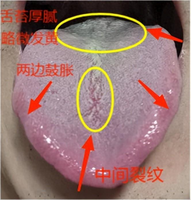 “ 过度敏感 ”？吃了地黄丸，右归丸没有用，原因出在舌头上
 
患者主诉：那方面