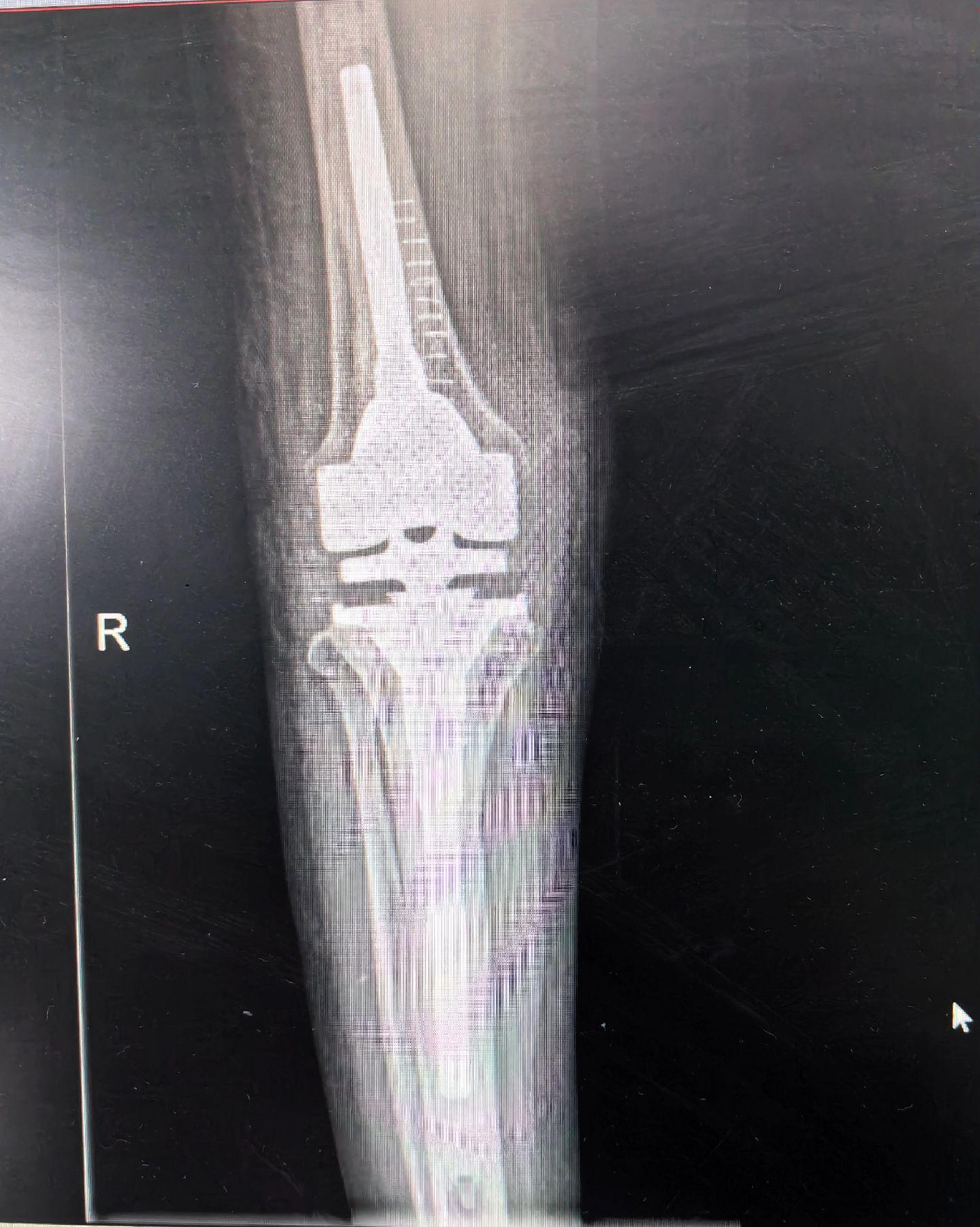 膝关节翻修。PJI，二期翻修。关节置换，谨防感染。