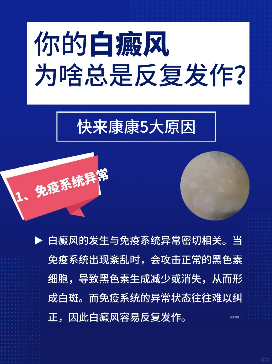 白斑白癜风总是反复发作，找到这几个原因！
