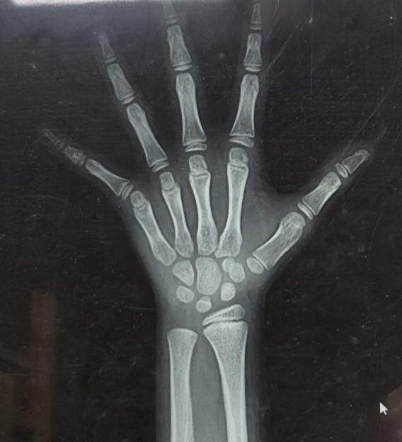 9岁娃身高才124cm，骨龄竟只有7岁？生长监测才是身高密码🔍
最近接诊了一位