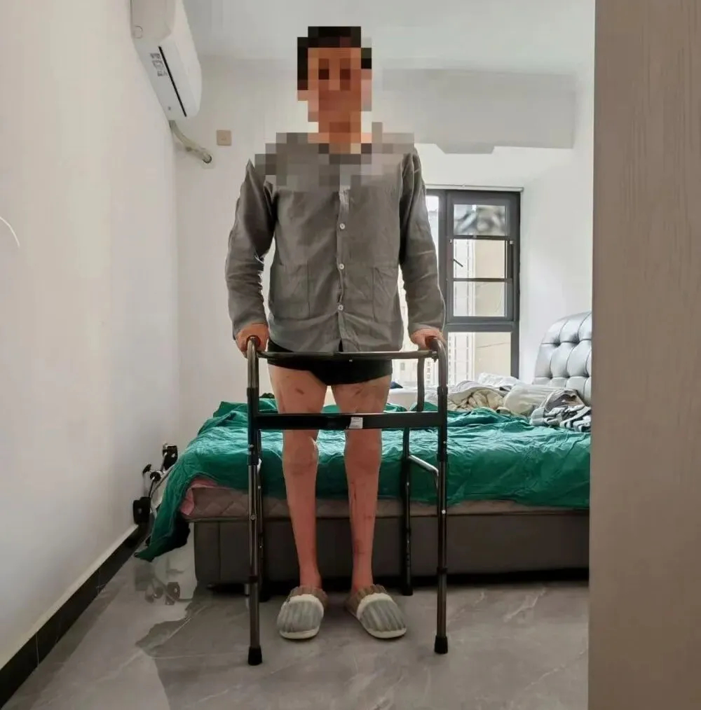 #双大腿离断近3小时被医生接回#【世界首例！#双大腿完全离体中国医生接回去了#】