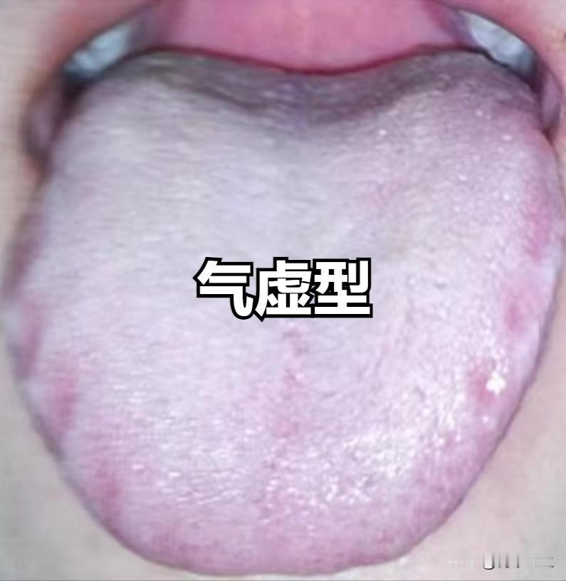 最难消除的齿痕舌，这两个原因很重要，知道了，调理很简单

齿痕舌的病因可以大致分
