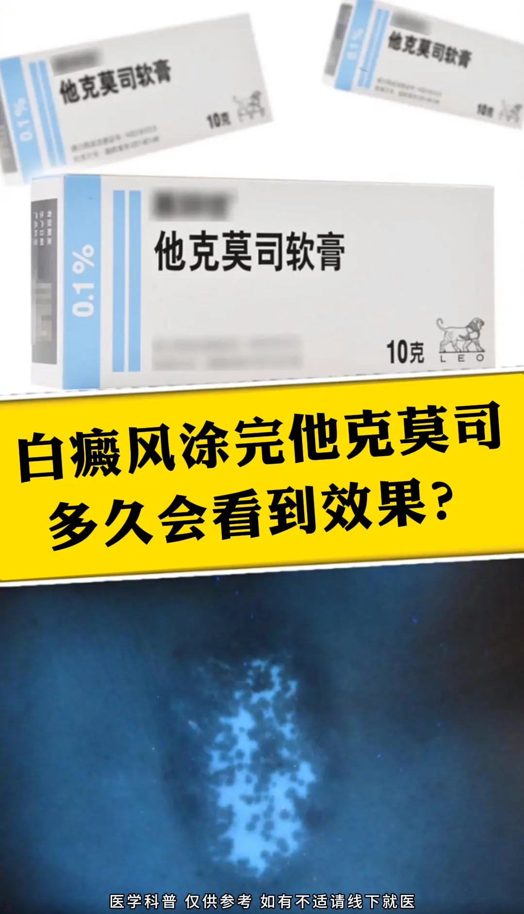 使用他克莫司治疗白癜风的见效时间因人而异，受到患者个体差异、病情严重程...