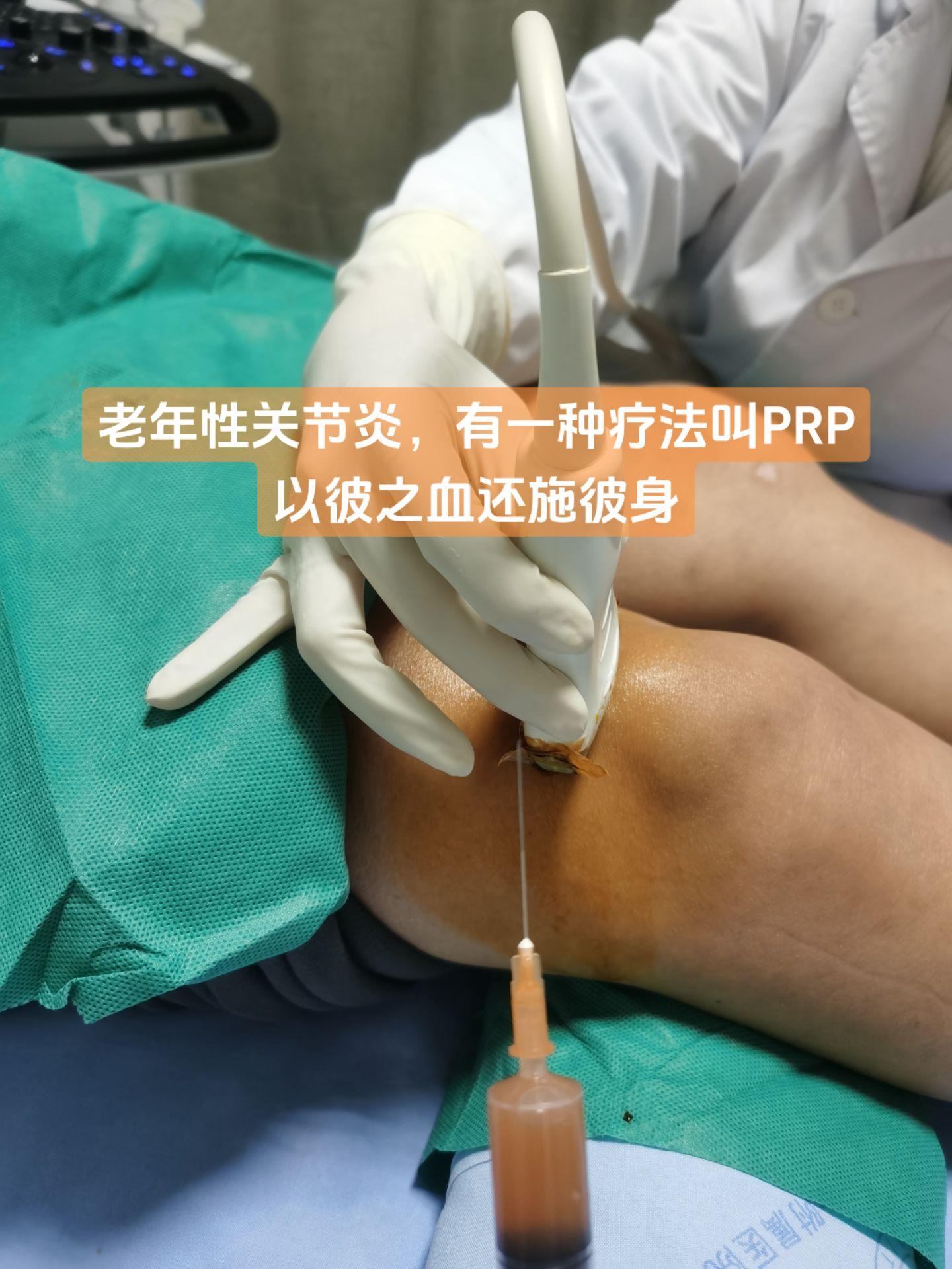 PRP中文名“富血小板血浆”注射治疗技术，以彼之血还施彼身，对老年性关节炎的作用，百度可知