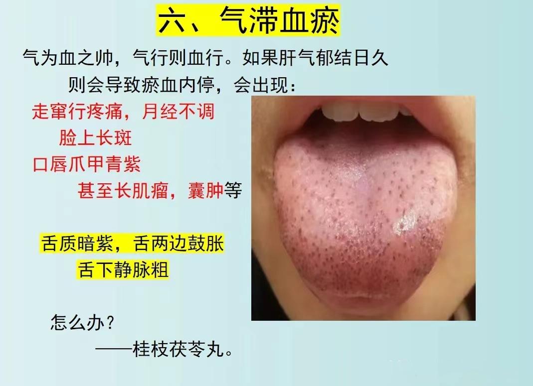 肝郁，为什么用逍遥丸无效？分清肝郁发展的阶段很重要！[给力][给力][给力]

