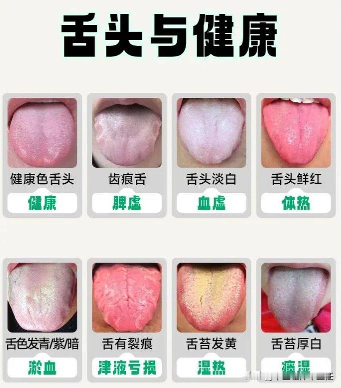 今日舌象分析进行中。。。

1、气虚——舌面凹陷
表现：精神萎靡，神疲乏力，容易