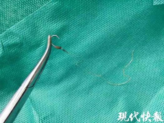 “太吓人了！”江苏一位59岁女子肛门刺痛，用手去摸摸到一根线，想也没想直接一拉，