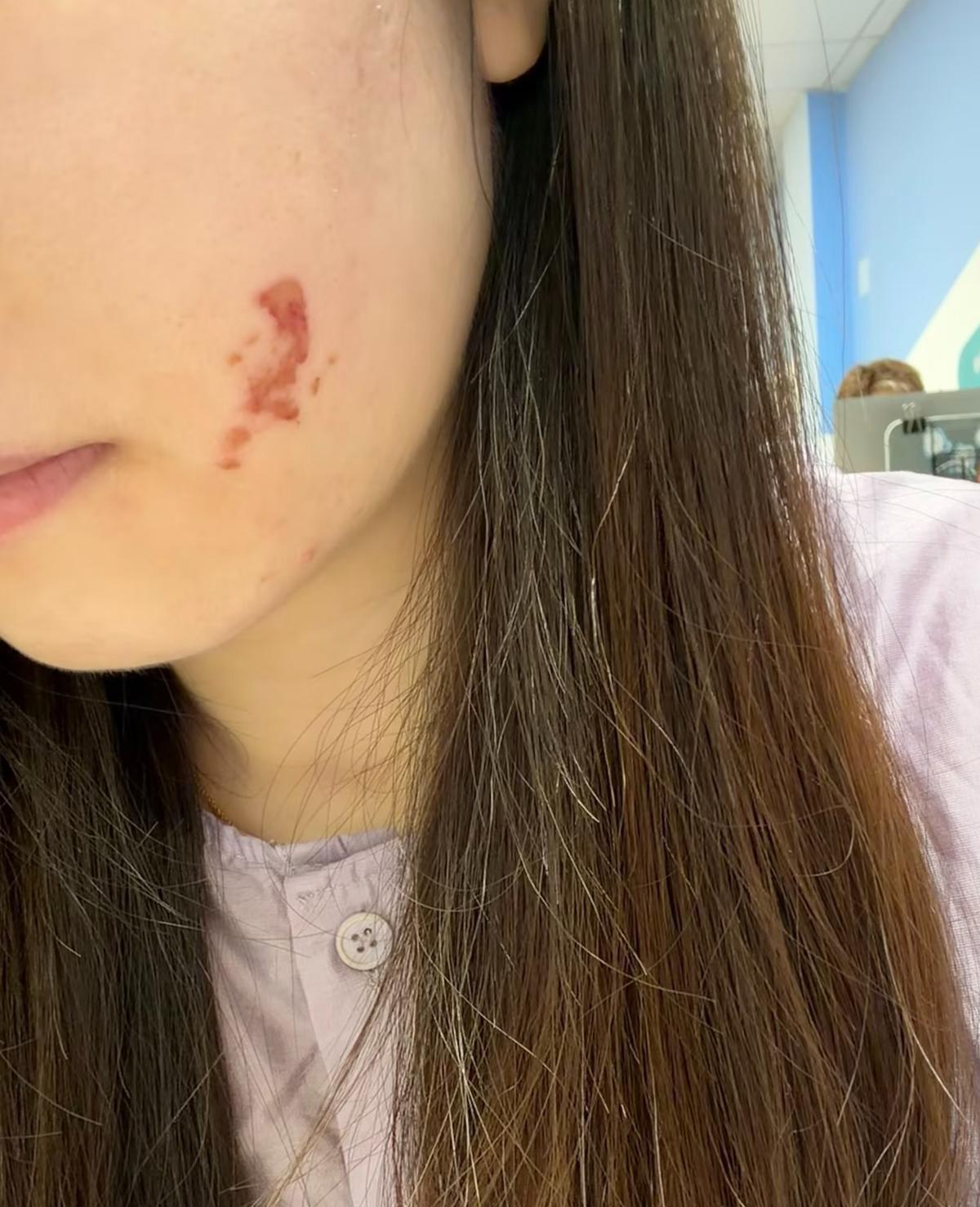 补牙补出面部灼伤！金华一女子脸发红起皮，涉事医师被辞退就够了吗？

10月5日，