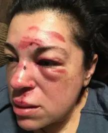 美国一女老师过人行道的时候摔了一跤，导致多处骨折与脑损伤，市政府赔了5300万元